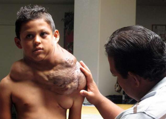 墨西哥9男孩脖子肩膀长出巨可怕的肿瘤4