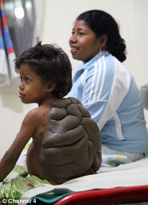 奇闻异事：哥伦比亚男童脱除“乌龟背”