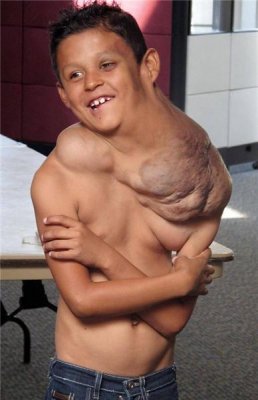 吓人，墨西哥9岁男孩脖子肩膀长出超可怕的肿瘤！