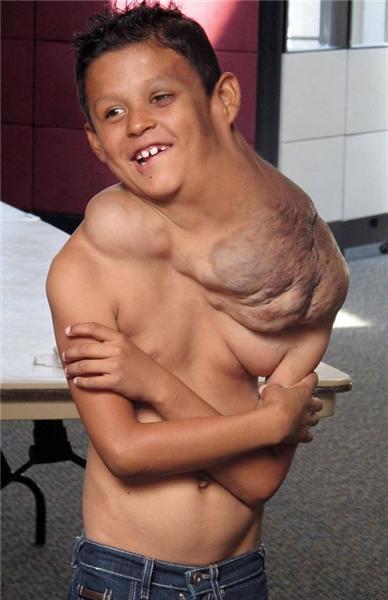 墨西哥9男孩脖子肩膀长出巨可怕的肿瘤1