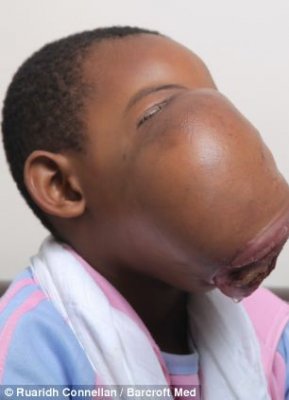 奇闻异事：乌干达女童成功摘除巨大的面部肿瘤！