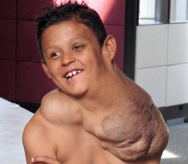 墨西哥9男孩脖子肩膀长出巨可怕的肿瘤3