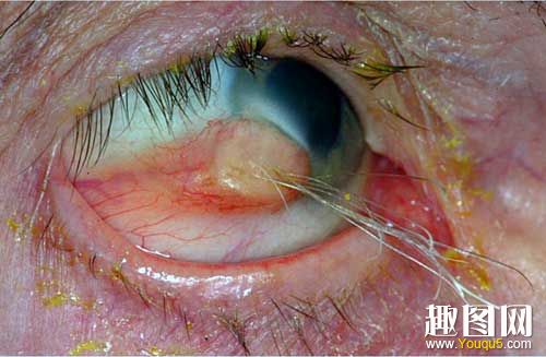 囊性畸胎瘤的眼球人的头发生长在他的眼球