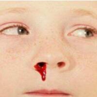 小孩流鼻血是什么原因，多种原因不可轻视!