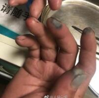 环卫工双手被腐蚀，原因是不小心触碰到塑料瓶内洒出的化学物质